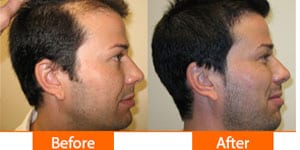 Thickening hairline with successful hair transplant at ASG Hair Transplant Centre.
