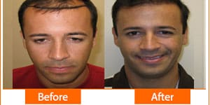 Natural hair transplant results at ASG Hair Transplant Centre showing before and after transformation.