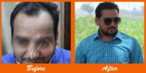 Healthy hair restoration results after transplant procedure.