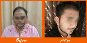 Fine hair transplant patient before and after treatment at ASG Hair Transplant Centre.