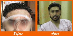 Healthy hair restoration process at ASG Hair Transplant Centre, before and after results.