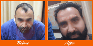 Natural hair restoration before and after results at ASG Hair Transplant Centre.