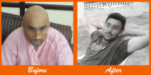 Natural hair restoration patient before and after procedure.