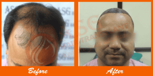 Thinning hair before and full hair after hair transplant at ASG Hair Transplant Centre.