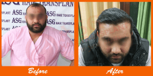 Male patient before and after hair transplant at ASG Hair Transplant Centre, showcasing natural results.