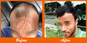 Thinning hair before and after hair transplant at ASG Hair Transplant Centre.