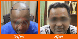 Clon hair transplant before and after results at ASG Hair Transplant Centre.
