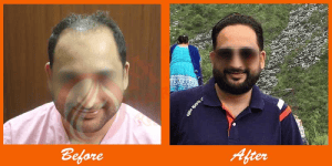 Thinning hair before and full head of hair after transplant at ASG Hair Transplant Centre.