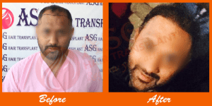- ALT: Hair transplant procedure before and after results at ASG Hair Transplant Centre.