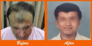 Fine hair transplant results at ASG Hair Transplant Centre, achieving natural, full hair restoration.