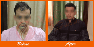Thin-haired man before and after hair transplant results at ASG Hair Transplant Centre.