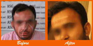 Low-light image of a man showing before and after hair transplant results at ASG Hair Transplant Centre.