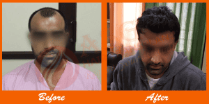 Realistic hair transplant before and after results at ASG Hair Transplant Centre.