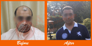 Follicular Unit Hair Transplant Before and After at ASG Hair Transplant Centre.