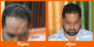 Natural hair restoration results after transplant at ASG Hair Transplant Centre.