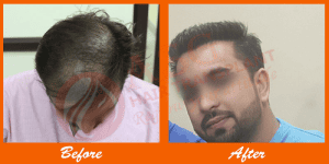Thinning hair and hair restoration before and after results at ASG Hair Transplant Centre.