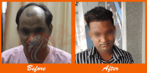 Fine hair restoration before and after in an ASG Hair Transplant Centre patient.