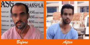 Better Hair Transplant Results: Before and After Photos at ASG Hair Transplant Centre.