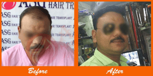 High-quality hair transformation after transplant at ASG Hair Transplant Centre.