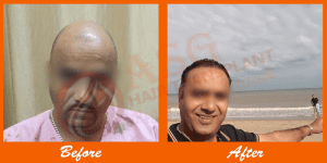 Bald man before and after hair transplant at ASG Hair Transplant Centre.