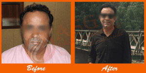 Thin-haired man before hair transplant, showing scalp issues and hair loss treatment.