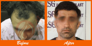 Thick hair restoration after transplant at ASG Hair Transplant Centre.