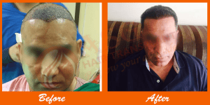 Thin-haired man receiving hair transplant treatment at ASG Hair Transplant Centre.
