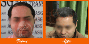 Gentlemen's hair transplant before and after transformation at ASG Hair Transplant Centre.