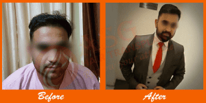 - A man before and after hair transplant at ASG Hair Transplant Centre.