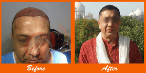 Thick hair transformation after hair transplant at ASG Hair Transplant Centre.