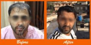 Reduced hair loss patient before and after hair transplant at ASG Hair Transplant Centre.
