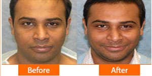 Thickening hairline with expert hair transplant at ASG Hair Transplant Centre.