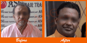 Struggling with hair loss before and after results at ASG Hair Transplant Centre.