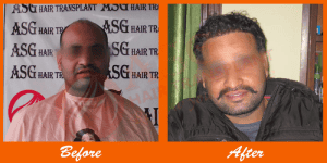 Thick hair transformation after hair transplant at ASG Hair Transplant Centre.