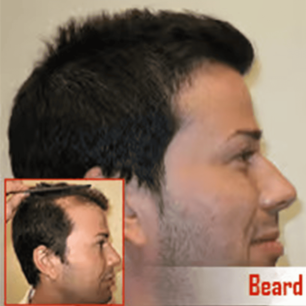 Full head hair transplant before and after at ASG Hair Transplant Centre, expert in hair restoration.
