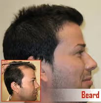 Thick hair after beard hair transplant at ASG Hair Transplant Centre.