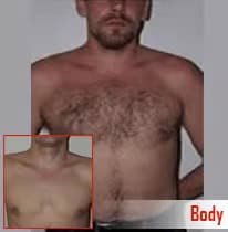 Natural male chest hair before hair transplant treatment.