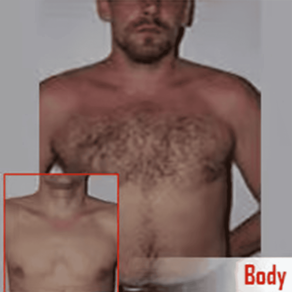 Thinning hair transformation before hair transplant at ASG Hair Transplant Centre.