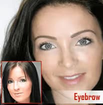 Eyebrow hair transplant before and after results.