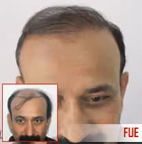 Thinning hair before hair transplant at ASG Hair Transplant Centre.