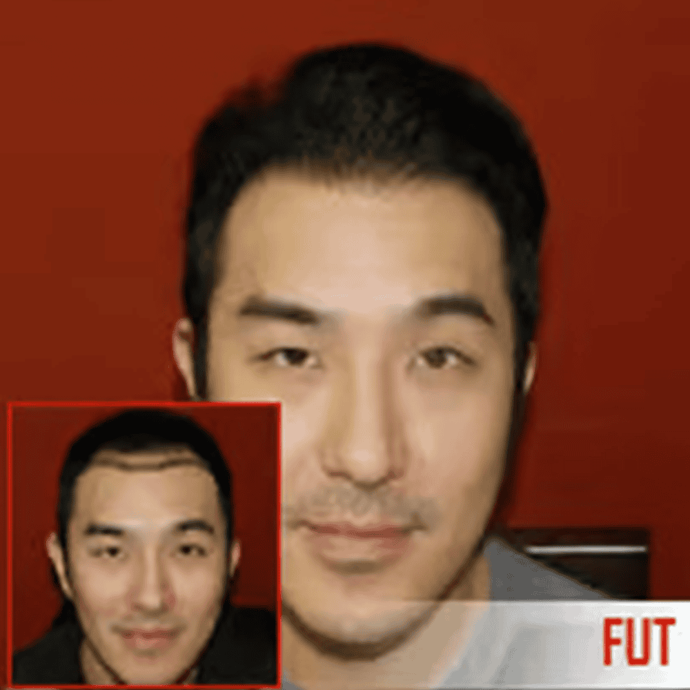 - Natural hair restoration results at ASG Hair Transplant Centre for hair loss treatment in men.