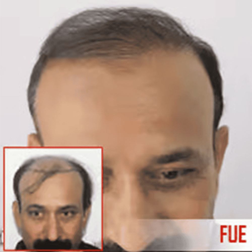 Thinning hair before hair transplant at ASG Hair Transplant Centre.