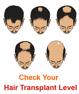 Natural hair transplant before and after results showcasing hair growth.
