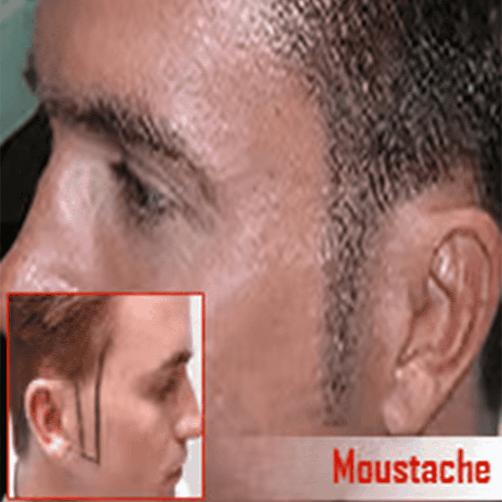 Thick hair and hair transplant procedure at ASG Hair Transplant Centre.