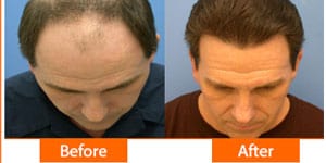 Thinning hair before and after hair transplant at ASG Hair Transplant Centre.