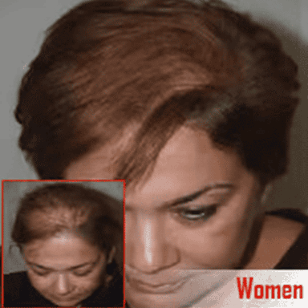 Fine hair hair transplant for women at ASG Hair Transplant Centre, restoring confidence and natural hair density.