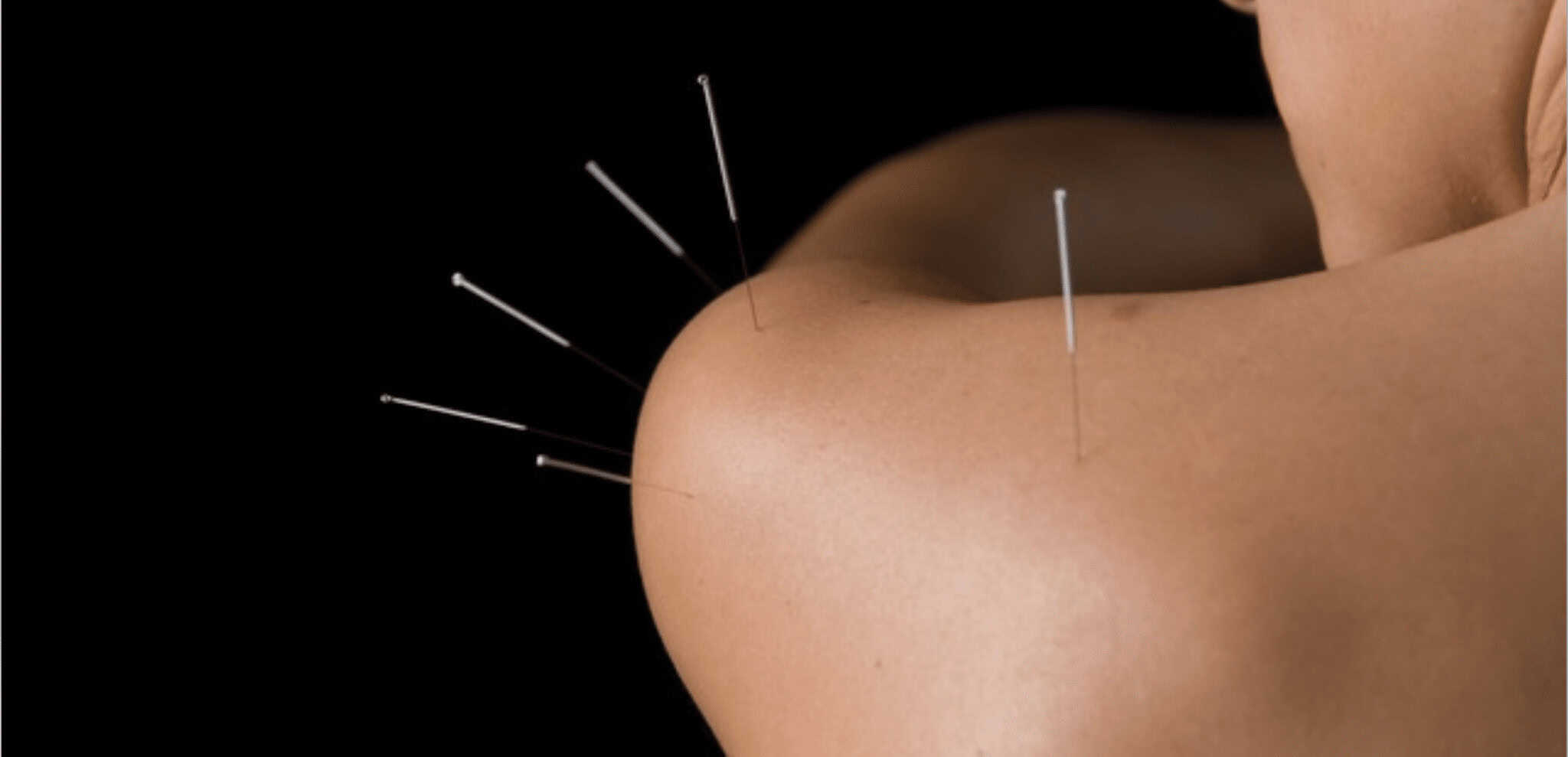 Acupuncture