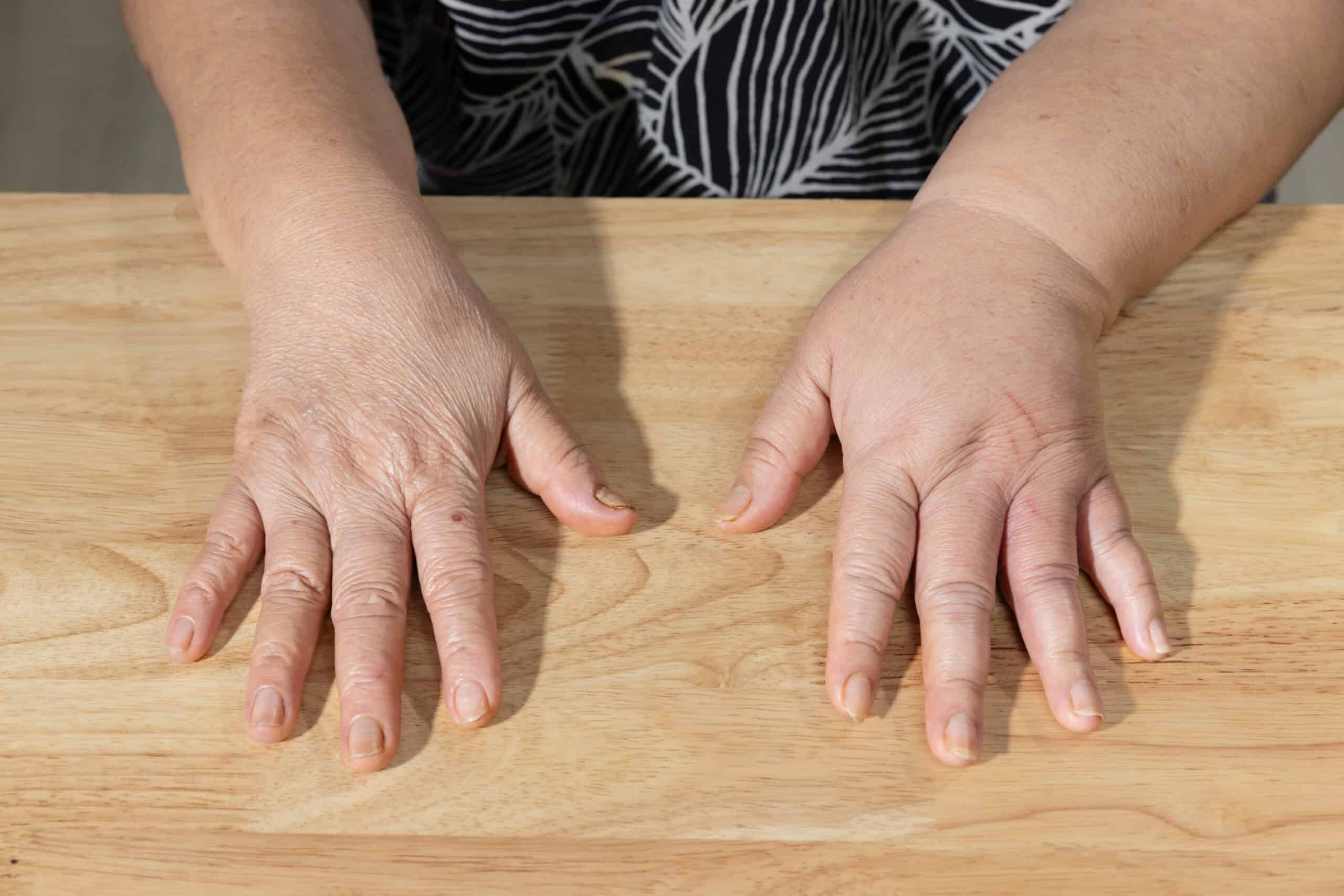lymphoedema hand, swollen hand