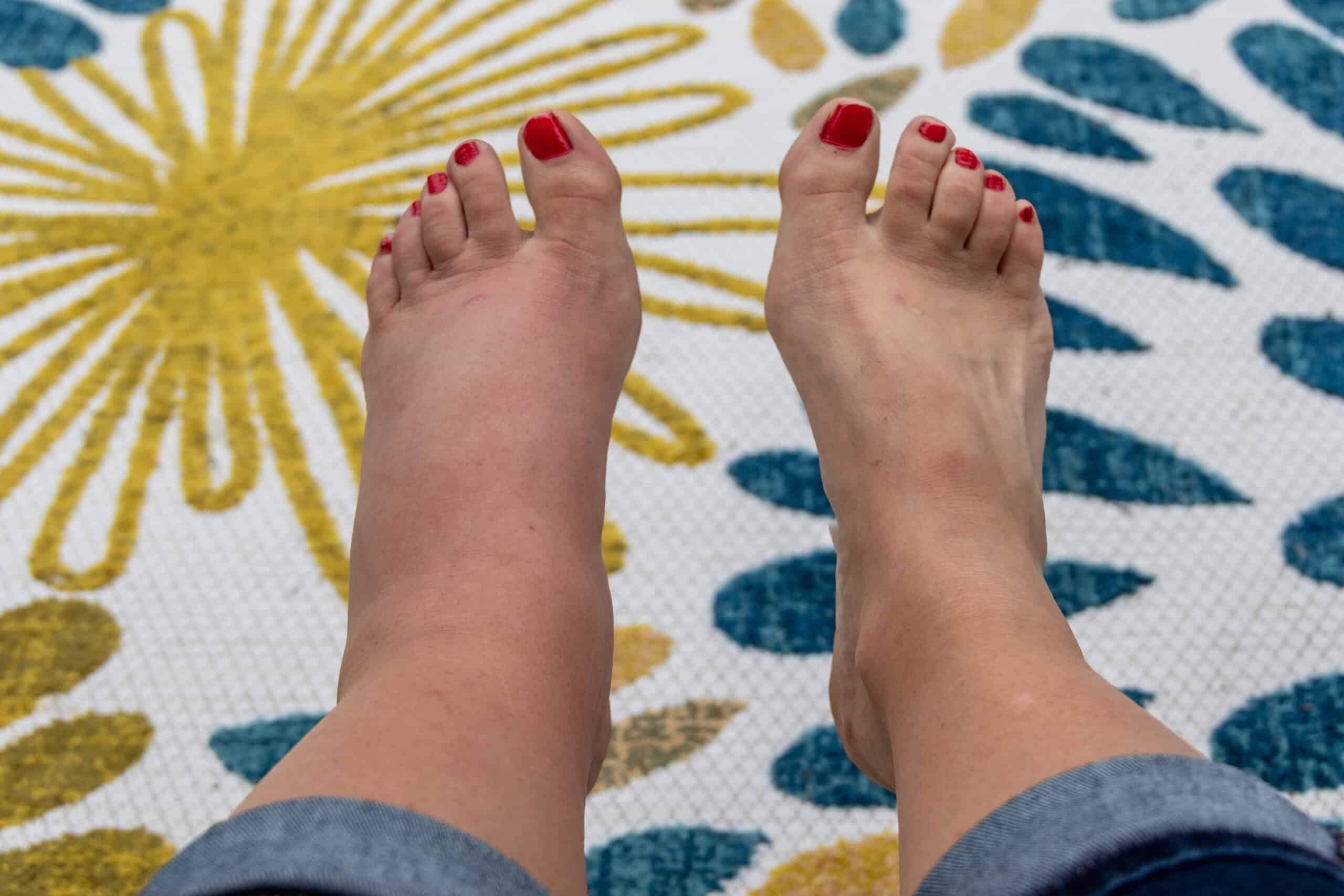 Living with Lymphoedema