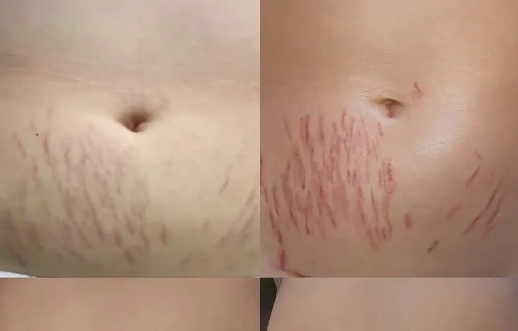 Chloe’s Stretch Mark Revision